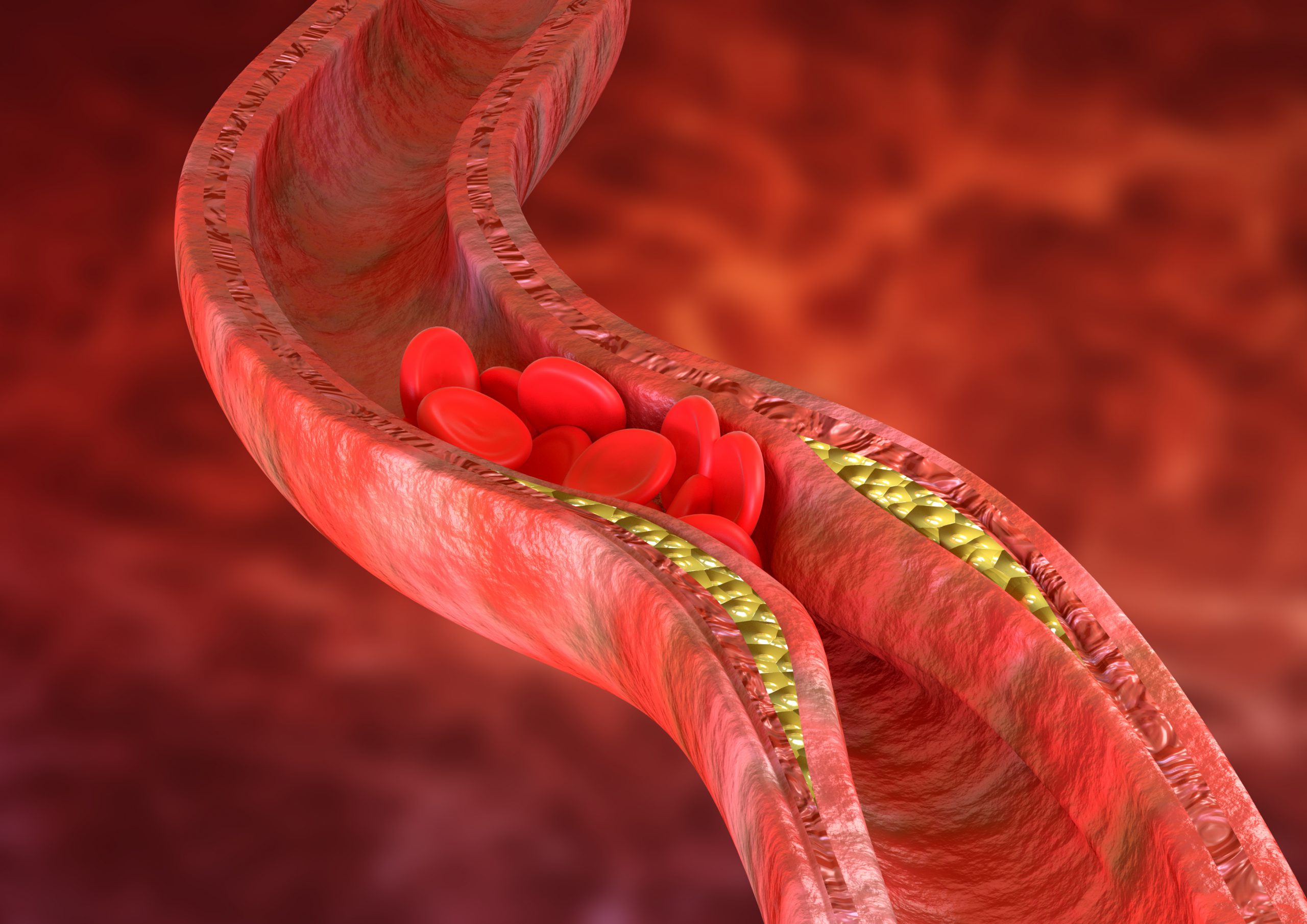 Atherosclerosis is an accumulation of cholesterol plaques in the walls